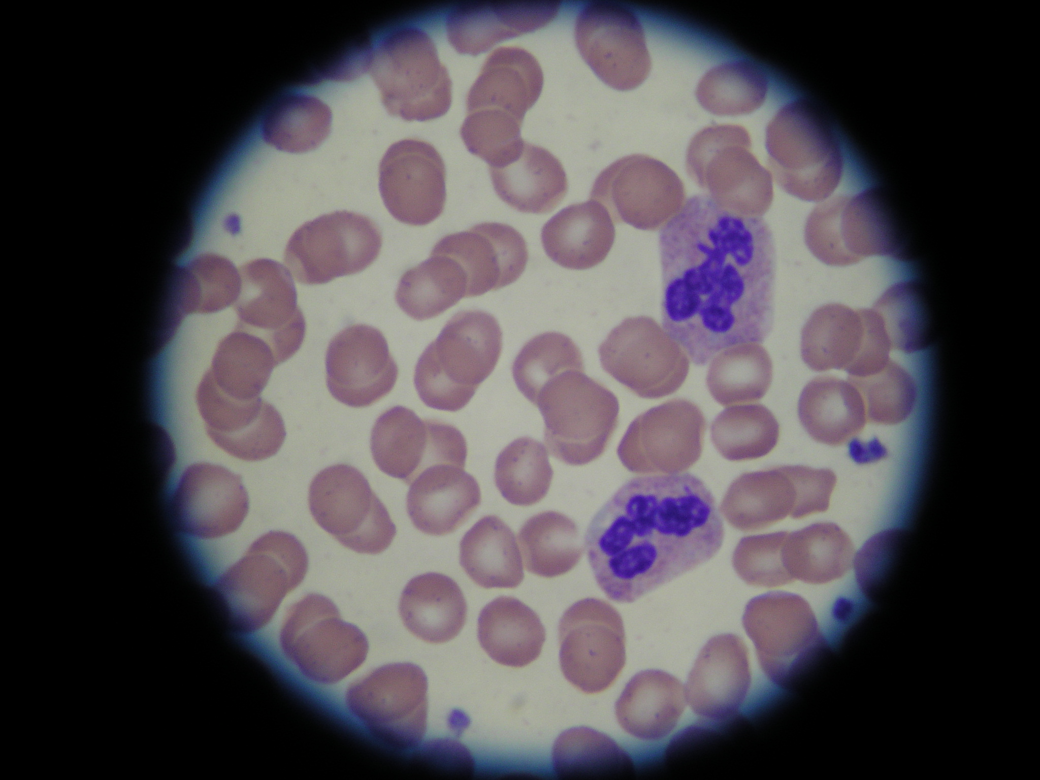 光镜下慢性淋巴细胞白血病(CLL)血液涂片照片摄影图片_ID:318175084-Veer图库